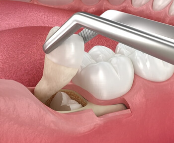 Normal Extraction