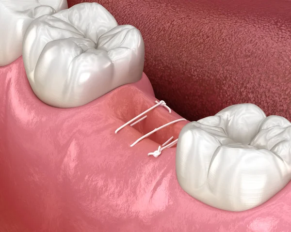 Stitch Removal