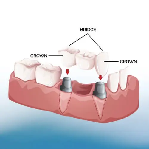 Dental Bridge (Porcelain, per tooth)