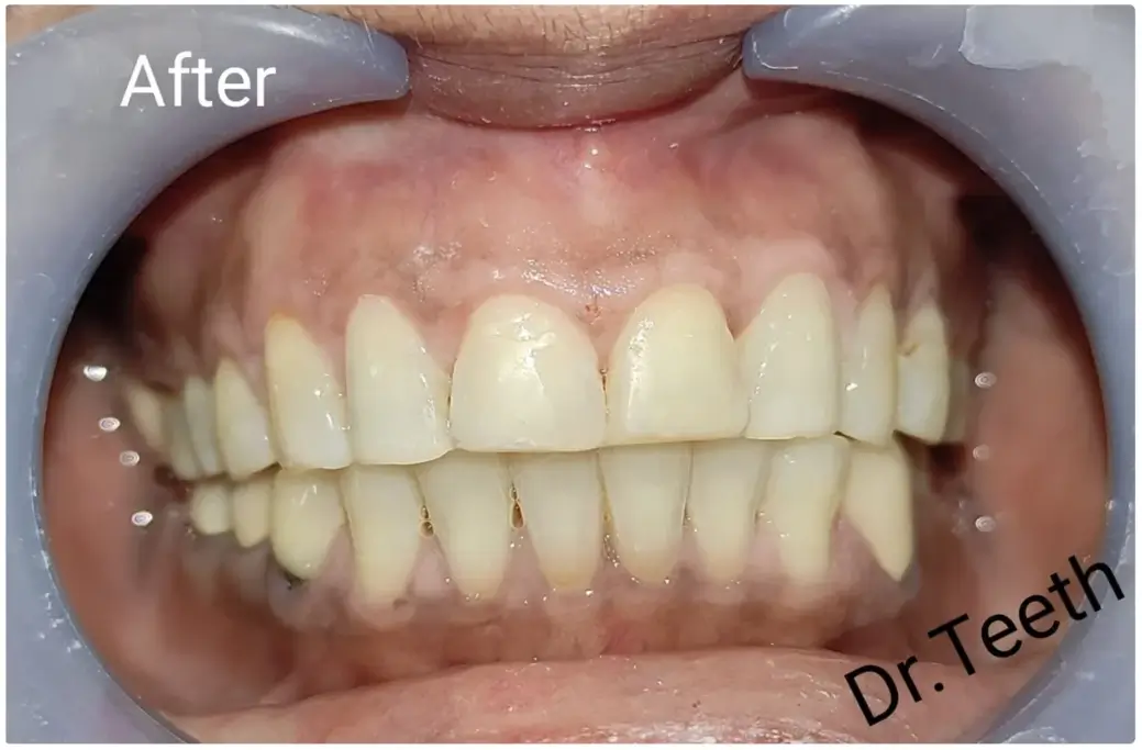 After Treatment