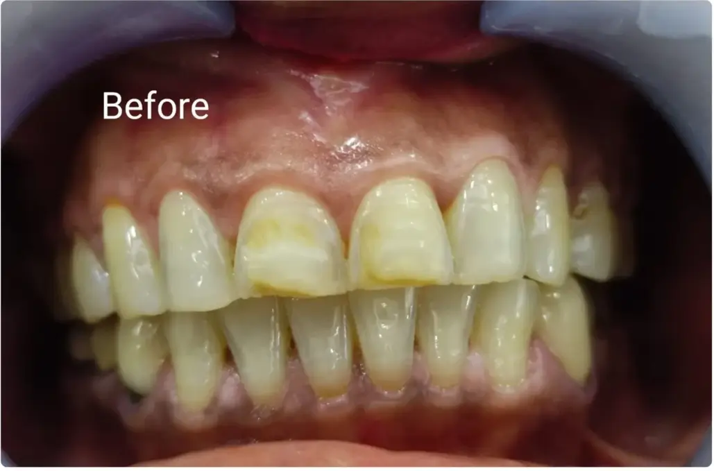 Before Treatment